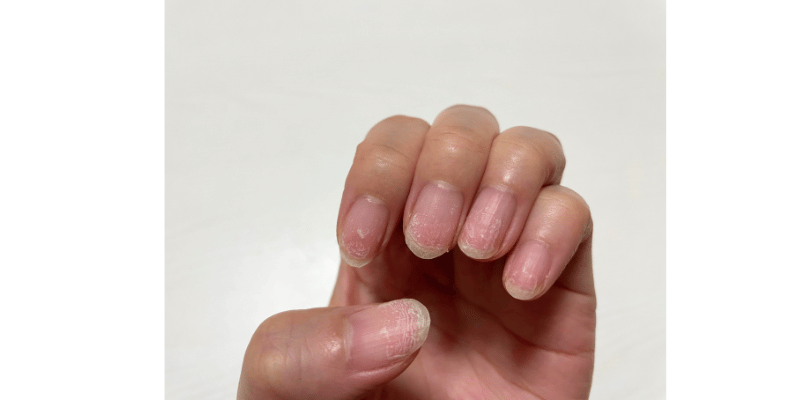 傷んで白くなった爪